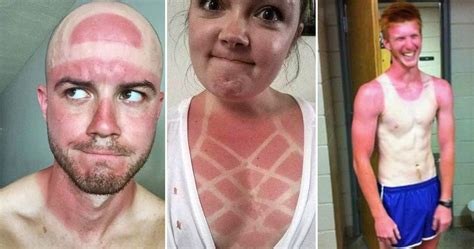 Sunburn Regrets People Who DEFINITELY Should Have Worn Sunscreen