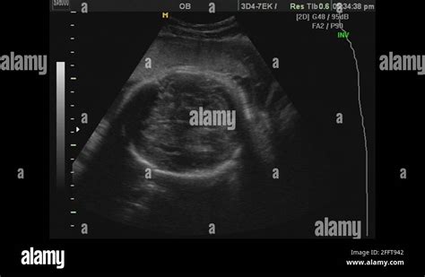 Fetal 2d Ultrasound Head Showing Hair Text Stock Video Footage Alamy