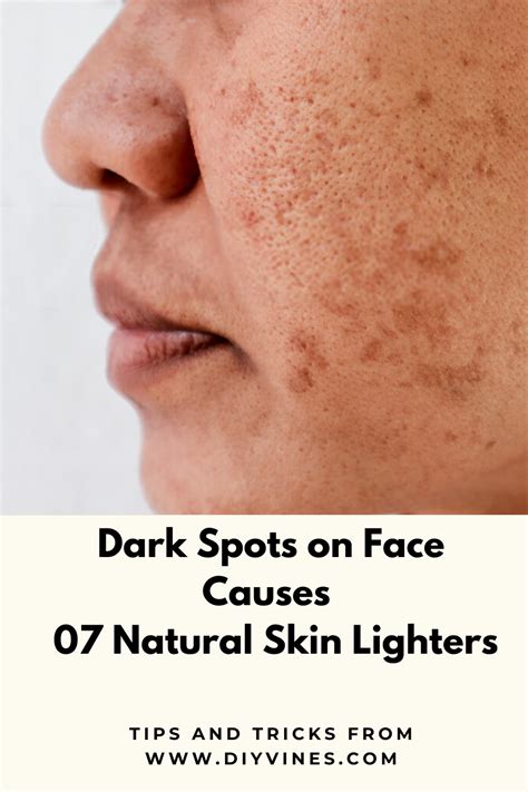 Dark Spots On Face Causes Are Increase Production Of Melanin In Skin