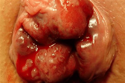 Por se tratar de um quadro benigno, muitas vezes. Hemorroidas | Blog Medprime