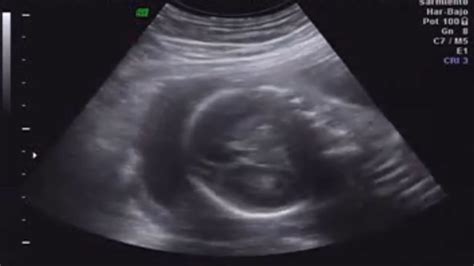 Ultrasonido De 5 Meses De Embarazo 20 Semanas YouTube