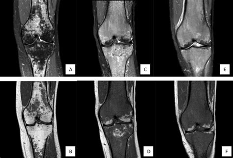 Mri Of The Left Knee Showing Multiple Focal Bone Marrow Lesions Which