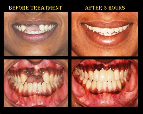 Front Tooth Replacement With Basal Implants