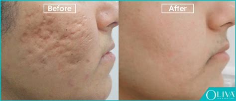 Boxcar Scars Treatments Results And Prevention