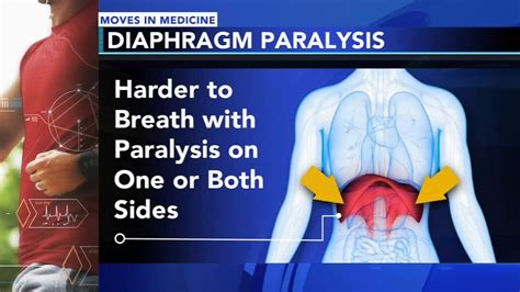 Paralyzed Diaphragm Breathing Techniques