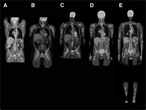 What Is Pet Ct Scan Whole Body Ct Scan Machine