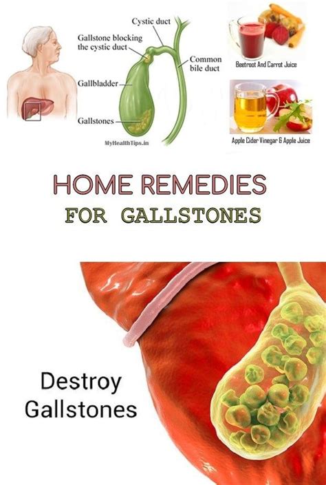 Home Remedies For Gallstones Mind Blowing Page Home Remedies