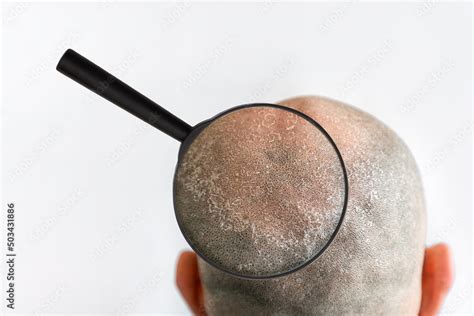 Mans Bald Flaky Head With Dandruff And Zoomed With Magnifier Problem