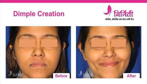 Dimple Creation Surgery Quick Painless And Permanent