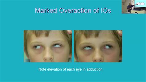 Lecture Advanced Surgical Techniques Vertical Strabismus Dr Rudolph Wagner Youtube