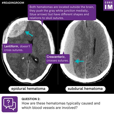 Where Are These Two Hematomas Located And How Can You Tell Them Apart
