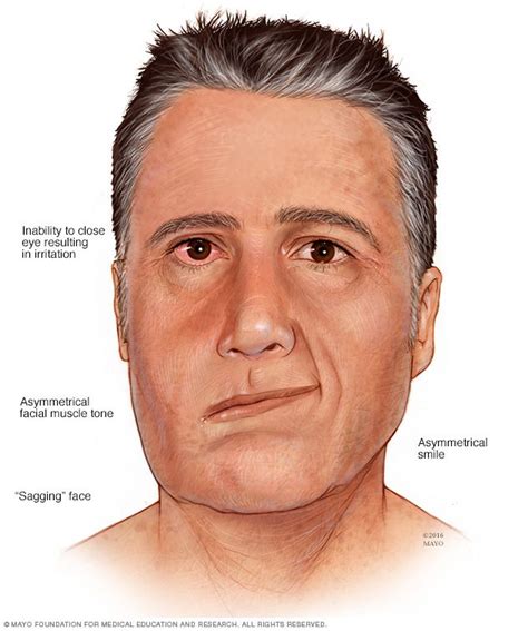 In addition to the painful shingles rash, ramsay hunt syndrome can. Facial paralysis | Symptoms, Syndrome