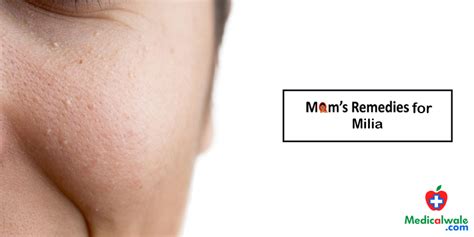 Moms Remedies For Milia Milia Treatment