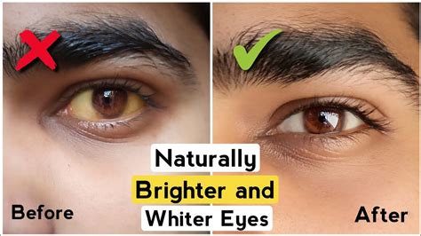 4 Tips To Get Brighter And Whiter Eyes Get Rid Of Yellow Eyes White