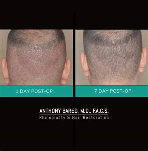 Best Hair Transplant Surgery In Miami Fl Dr Anthony Bared