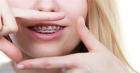 Fixing Jaw Alignment With Braces Nevada Dentistry And Braces