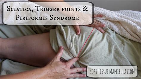 Sciatica Trigger Points Piriformis Syndrome Soft Tissue