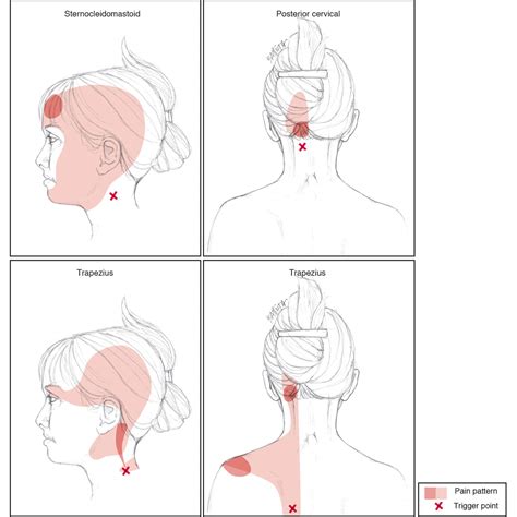 Head And Neck Trigger Points 1° And 2° Pain Patterns Battista