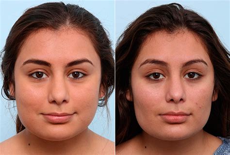 Buccal Fat Pad Removal Photos Houston Tx Patient