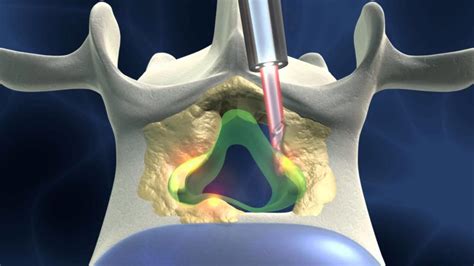 Technical Aspects Of The Percutaneous Cervical And Lumbar Laser Disc