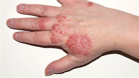 Eczema Symptoms Treatment Causes More