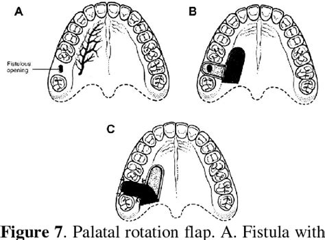 Palatal Rotation Flap In Management Of Oroantral Fistula With Left