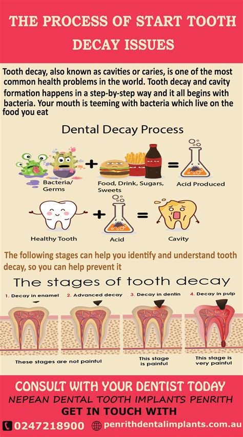 The Start Process Of Tooth Decay Issues Dental Tooth Decay Is The