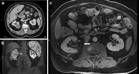 A Initial CT Scan Showing Right Renal Mass B MRI Showing Increase In
