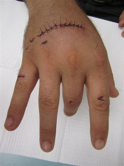 Hand Anatomy Extensor Tendons