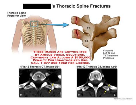 AMICUS Illustration Of Amicus Injury Fracture Spine T2 T3 CT Transverse