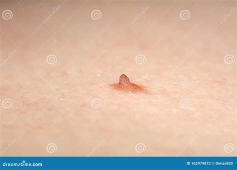 Papilloma Nevus Or Mole On Human Skin Stock Photo Image Of Pain