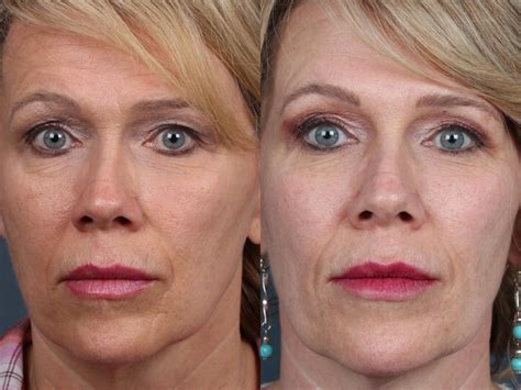 Pico Genesis Laser Treatment Before And After Photos Patient 688