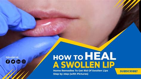 5 Methods That Can Help To Reduce Swollen Lip Fast At Home Youtube