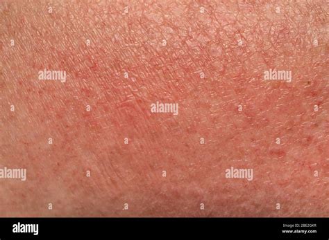 Skin Manifestations Of An Allergic Reaction To The Sun Close Up Soft
