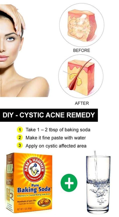 How To Remove Cystic Acne
