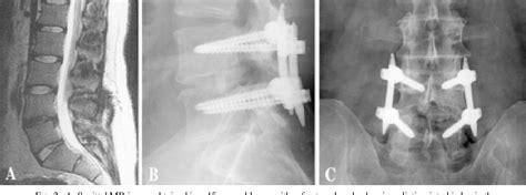 Pdf Minimally Invasive Transforaminal Lumbar Interbody Fusion