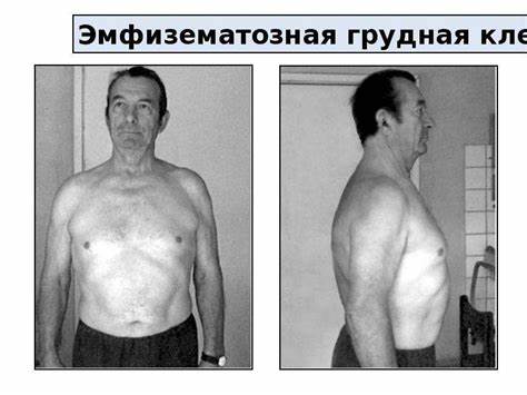 Хронический бронхит и диеты Хронический бронхит и ХОБЛ - презентация, доклад, проект скачать Хронический бронхит и ХОБЛ - презентация, доклад, проект скачать Хронический бронхит и диеты