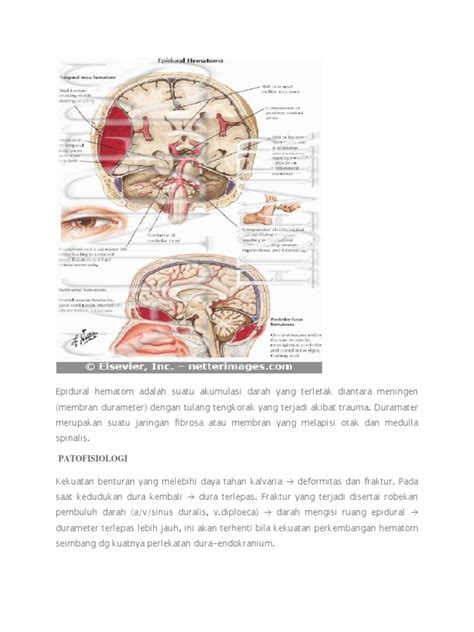 Epidural Hematom Pdf