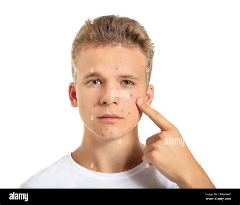 Teenage Boy With Acne Problem On White Background Stock Photo Alamy