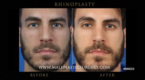 Nonsurgical rhinoplasty is an outpatient procedure, making it far more convenient than surgical alternatives. Male Rhinoplasty | Nose Job Men | Nose Plastic Surgery ...