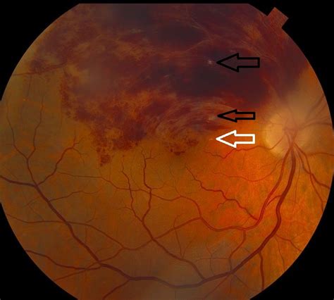 Branch Retinal Vein Occlusion In A Patient With Familial Hyperlipidemia
