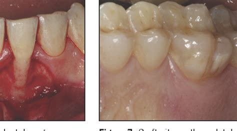 Figure 1 From Management Of Mandibular Anterior Teeth With Gingival
