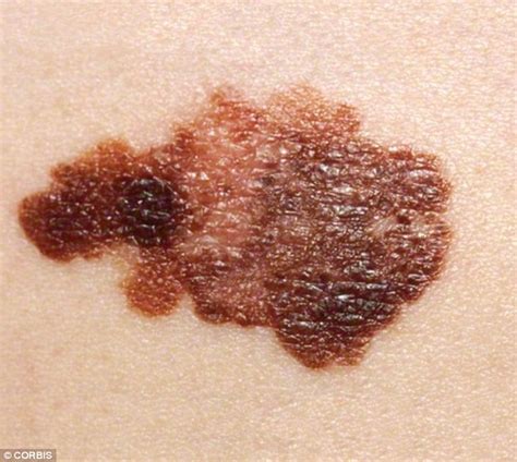 Is Your Mole Harmless Or Life Threatening Daily Mail Online