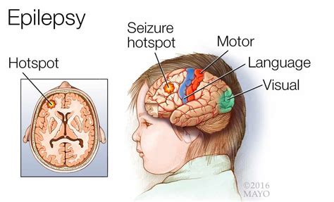 Medical Illustration Of A Brain With Epilepsy A Seizure Hotspot And The Motor Language And