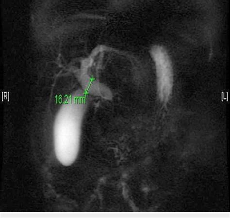 Magnetic Resonance Cholangiopancreatography Mrcp Dilatation Of The