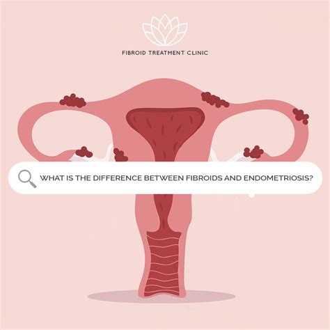 Difference Between Fibroids And Endometriosis Fibroid Treatment Clinic