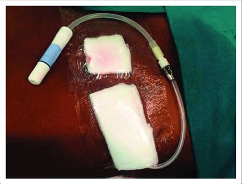 Peritoneal Dialysis Catheter After Being Covered With Dressings