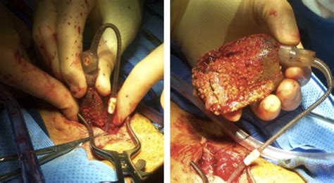 successful salvage reimplantation  penile prosthesis