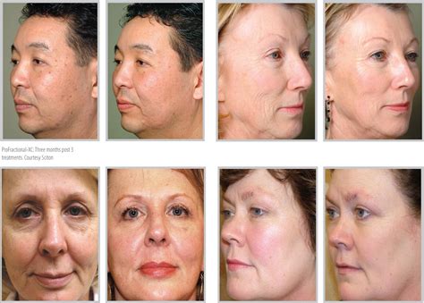 Before And After Renew Stem Cell And Laser