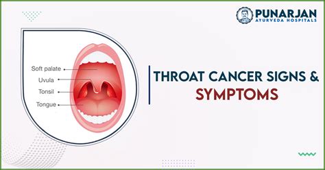 11 Symptoms Of Throat Cancer